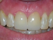 Harbor Dental Benicia crowns