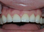 Harbor Dental Benicia teeth